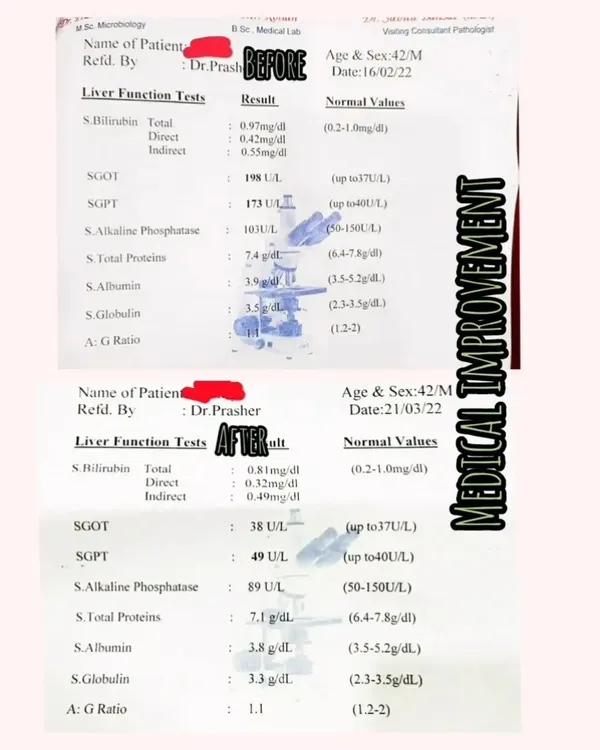 This is the kind of result that fuels my passion. This client's liver function tests showed significant improvement after just one month of following a personalized nutrition plan. We brought the SGOT and SGPT levels from high risk back into the normal range, demonstrating how targeted food choices can directly support liver health.