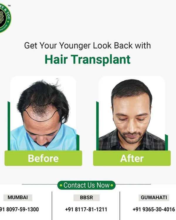 This before and after comparison clearly shows the journey from significant hair loss to a restored, younger look. The new hairline is designed to look completely natural, blending seamlessly with his existing hair.