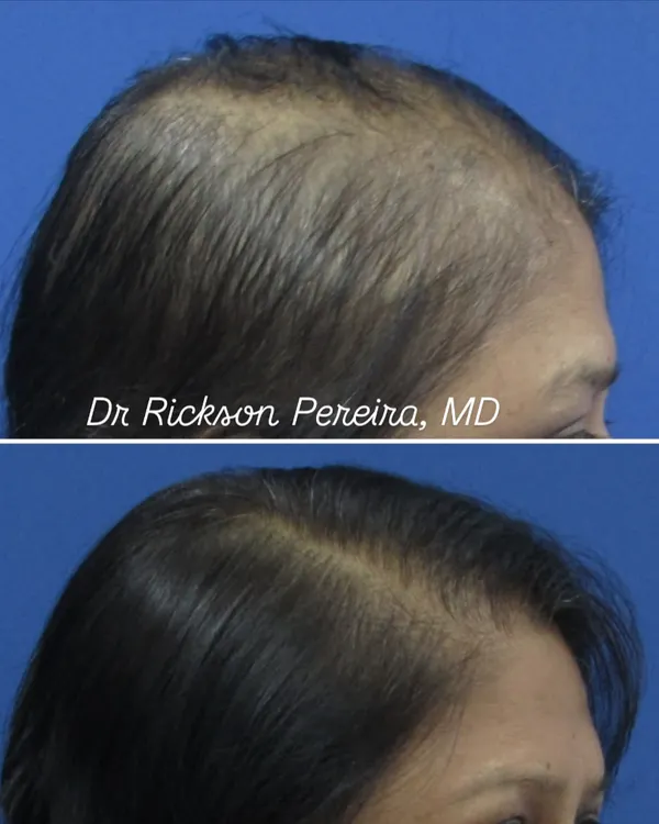 This side profile demonstrates significant improvement in hair density for a patient with female pattern hair loss. With a consistent, science-led treatment protocol, even advanced cases can see great results.