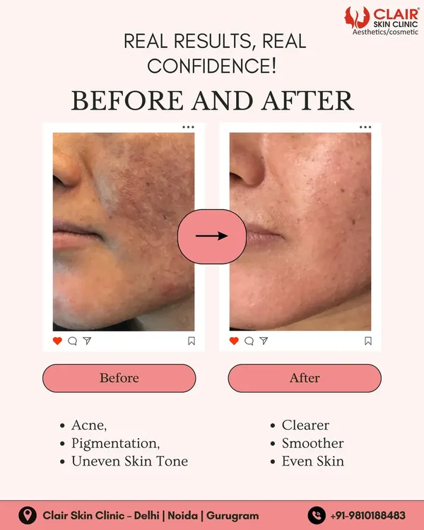 Real results are the foundation of real confidence. We create personalized treatment plans to address concerns like acne, pigmentation, and uneven skin tone, revealing a clearer, smoother complexion you can feel proud of.