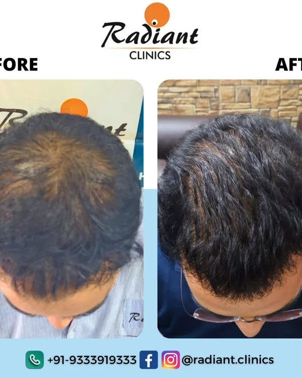 This is the kind of result we can achieve with non-surgical PRP therapy. The image on the left shows significant thinning at the crown. After a planned course of treatment, you can see the visible improvement in hair density and scalp coverage on the right. This is not an overnight fix, but with patience, we can achieve substantial natural hair regrowth.