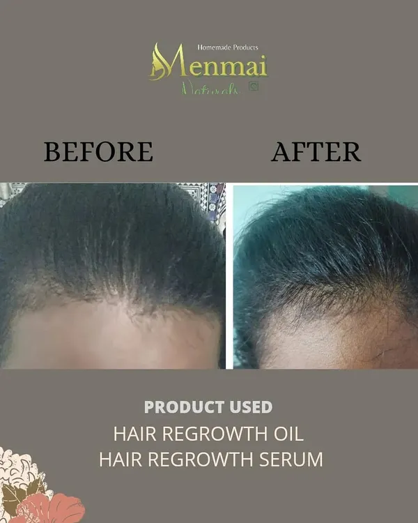 This is the result of just two weeks of using my Hair Regrowth Serum and two months of my Hair Regrowth Oil. I am so happy to see such clear progress with new hair growth filling in the hairline. Consistency is truly the key.