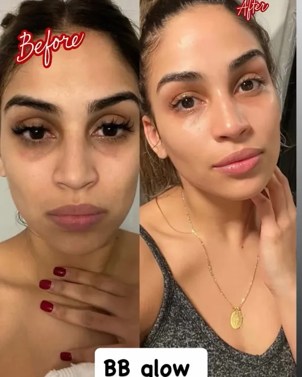 This is the power of a BB Glow treatment. Notice the visible reduction in under-eye darkness and uneven skin tone, replaced by a fresh, luminous complexion. My goal is to give you this kind of natural, "no-makeup" confidence right after a single session.