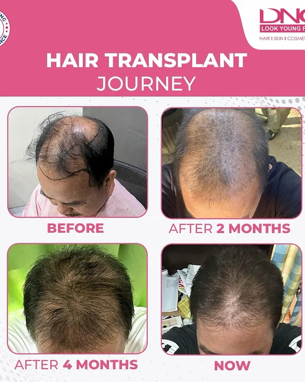 This patient's hair transplant journey shows the gradual but steady progress you can expect. From the initial stages to two months, four months, and the final result, you can see the density building up for a complete transformation.