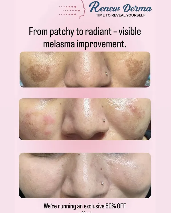 A fantastic example of visible melasma improvement. Our targeted treatments help break down stubborn pigmentation, leading to a more even and radiant skin tone.
