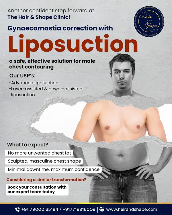 This graphic outlines what you can expect from a gynecomastia correction with liposuction. We use advanced, laser-assisted techniques to sculpt a masculine chest shape with minimal downtime, so you can stop hiding under baggy shirts.