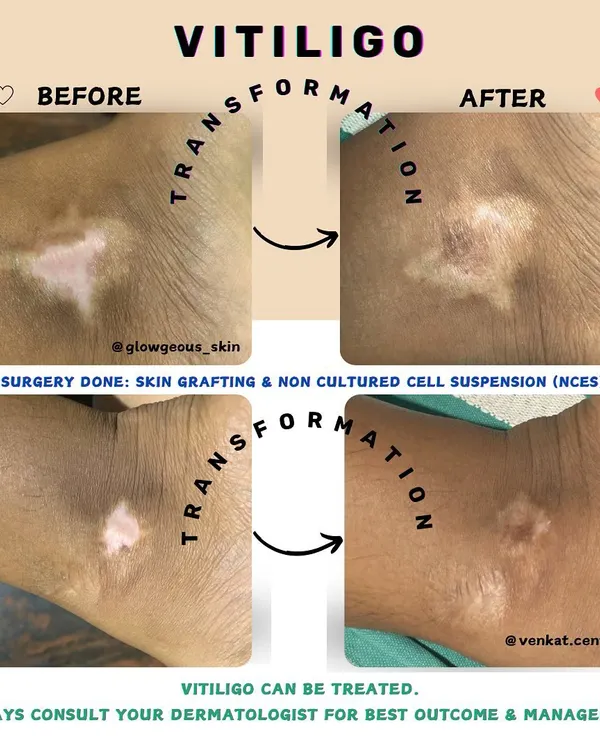 This is the power of a scientifically-backed treatment plan. For this patient with stable vitiligo, we used a combination of skin grafting and non-cultured cell suspension to restore pigmentation. This isn't a quick fix; it's a life-changing surgical procedure that offers real hope and lasting results.