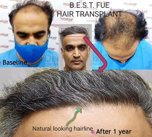 This collage shows the complete hair restoration journey one year after a B.E.S.T. FUE hair transplant. The focus on creating a natural-looking hairline is a critical part of my artistic and surgical approach to treating advanced baldness.