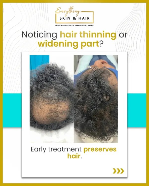 This before-and-after image shows the significant improvement in hair density possible with early and consistent treatment. We focus on preserving existing hair and stimulating new growth for natural-looking results.
