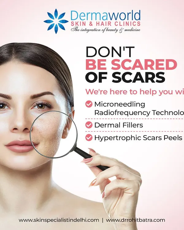 Don't be scared of scars. I offer several effective treatments to significantly improve their appearance. My methods include Microneedling RF to stimulate collagen, dermal fillers to lift depressed scars, and specialized peels for hypertrophic or raised scars.