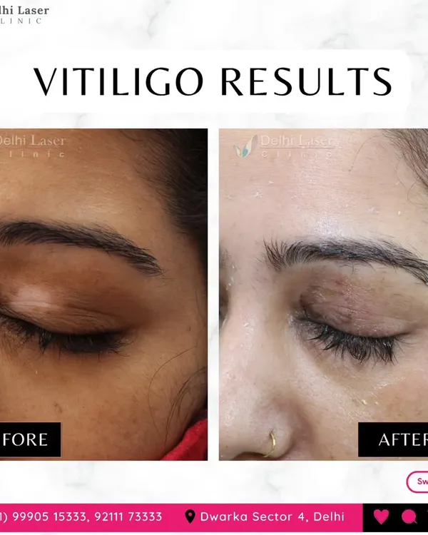 This before-and-after shows the re-pigmentation of a vitiligo patch on the eyelid. With precise and consistent treatment, it is possible to restore color to affected areas, even on sensitive parts of the face.