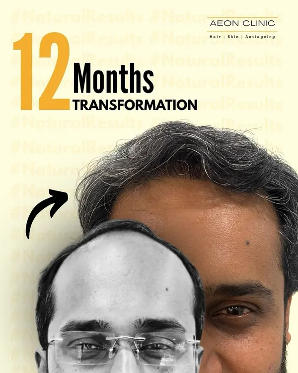 This is the result of a 12-month journey with us. We implanted over 4350 grafts in a single sitting to restore the hairline and mid-scalp, achieving a full, natural-looking transformation.