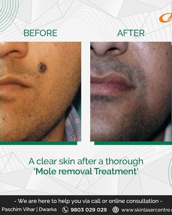 This before and after demonstrates a mole removal treatment. The procedure leaves the skin clear and smooth, addressing cosmetic concerns that such growths can cause.