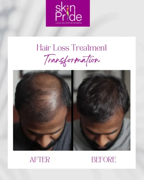 (Hero Media) Here is a real transformation from one of our clients. We focus on delivering visible results that not only restore hair but also bring back confidence, strand by strand. This is what our hair loss treatment journey can achieve.