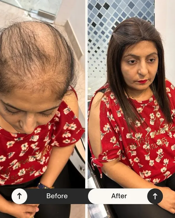 A powerful before-and-after transformation. This client was experiencing significant hair thinning, and our custom hair topper provided instant, natural-looking coverage and volume, completely changing her look and boosting her confidence.