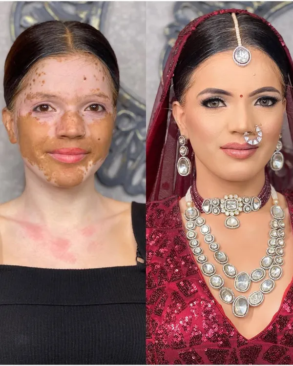 This is a before-and-after look on a model with vitiligo, showcasing a full coverage bridal transformation. I believe makeup is about empowerment, and my goal was to create a flawless, radiant base that felt comfortable and looked beautiful, celebrating her unique beauty on her special day.