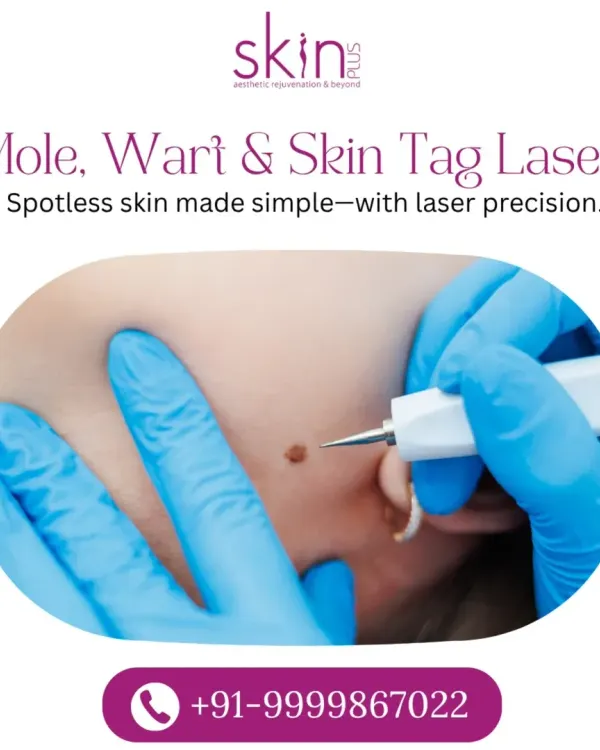 A close-up shot of a laser being used to remove a mole, illustrating the precision of the treatment. This service provides a simple solution for achieving spotless skin.