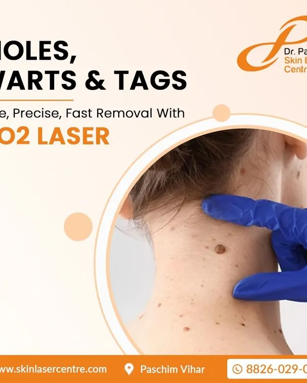 This image illustrates the common areas where skin tags and moles appear, such as the neck. My CO2 laser removal service is a safe, precise, and fast way to address these benign growths, providing a clear and smooth skin surface.
