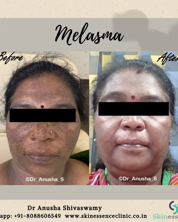 This before-and-after image shows a significant reduction in melasma after just one session of a specialized peel. You can see a dramatic improvement in the deep facial pigmentation, resulting in a much clearer and more even skin tone.