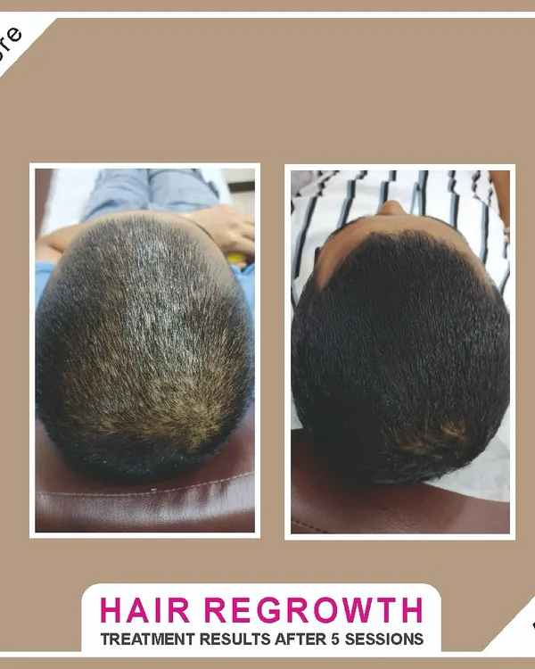 A top-down view showing a dramatic improvement in hair density for a client with male pattern baldness after 5 treatment sessions. The results speak for themselves.