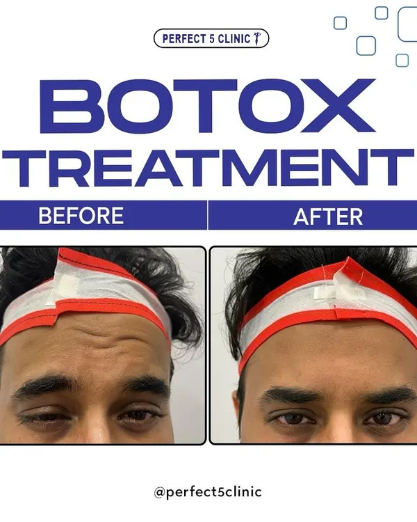 A clear before and after of our Botox treatment for forehead lines. Notice how the deep-set wrinkles are smoothed out, resulting in a more youthful and relaxed appearance.