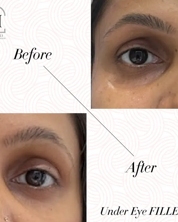 Tired-looking eyes can be effectively treated with under-eye fillers. This before and after shows how filling the hollows can instantly make you look more rested and refreshed in a single sitting.