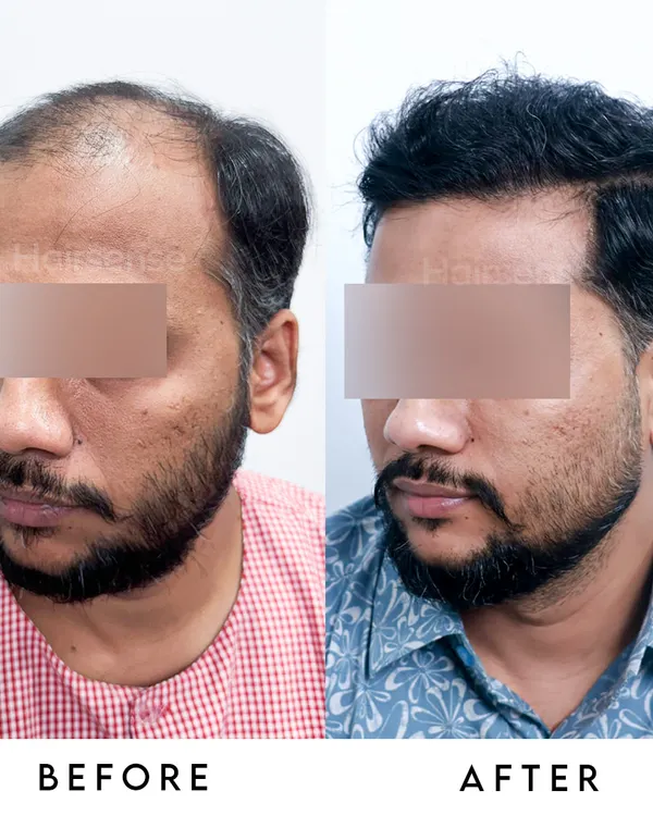 A comprehensive before and after view showing the significant improvement in density and the creation of a youthful, natural hairline.