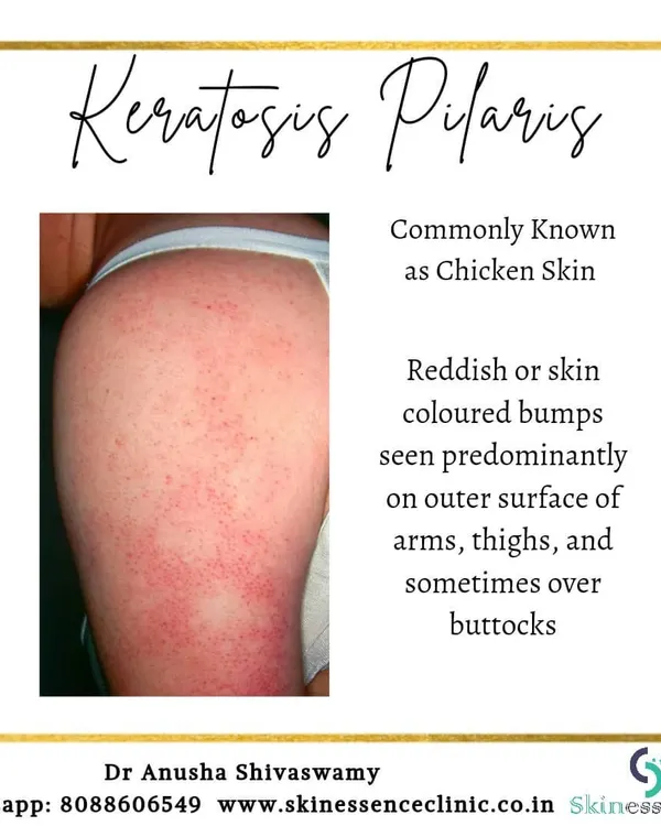This is Keratosis Pilaris, commonly known as "chicken skin." It presents as reddish or skin-colored bumps on the arms and thighs, giving the skin a rough, sandpaper-like texture. It is a harmless but common cosmetic concern.