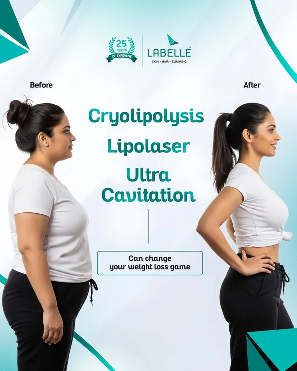 This is the power of a personalized transformation. By combining advanced, non-surgical treatments like Cryolipolysis, Lipolaser, and Ultra Cavitation, we help you achieve visible inch loss and a sculpted, toned physique.