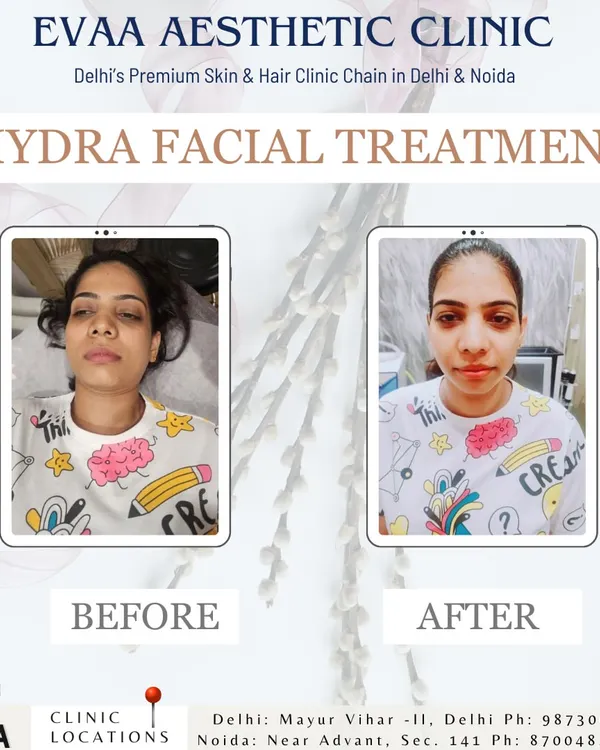A real client's before-and-after photos following a HydraFacial treatment, showcasing a brighter, refreshed, and more radiant complexion.