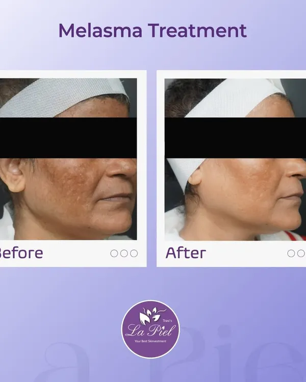 Melasma presents as dark, irregular patches on the face and requires a careful, sustained treatment approach. This before-and-after shows a significant reduction in melasma, revealing a clearer and more even complexion after a customized treatment plan.