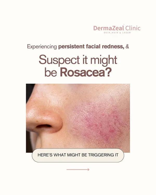 If you're experiencing persistent facial redness, you might suspect it's Rosacea. This guide explores the common triggers for this chronic skin condition.