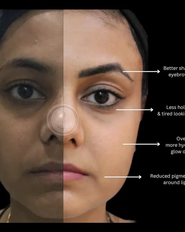 This before and after shows a comprehensive improvement in skin health. We successfully reduced pigmentation around the mouth, diminished the hollow look under the eyes, and achieved an overall hydrated glow through a series of targeted medi-facials.