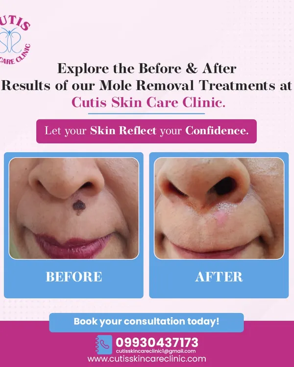 This before and after image shows the result of a dermatologist-supervised mole removal from the face. We used a precise technique to ensure the procedure was quick, safe, and left the skin smooth with minimal scarring, restoring our patient's confidence.