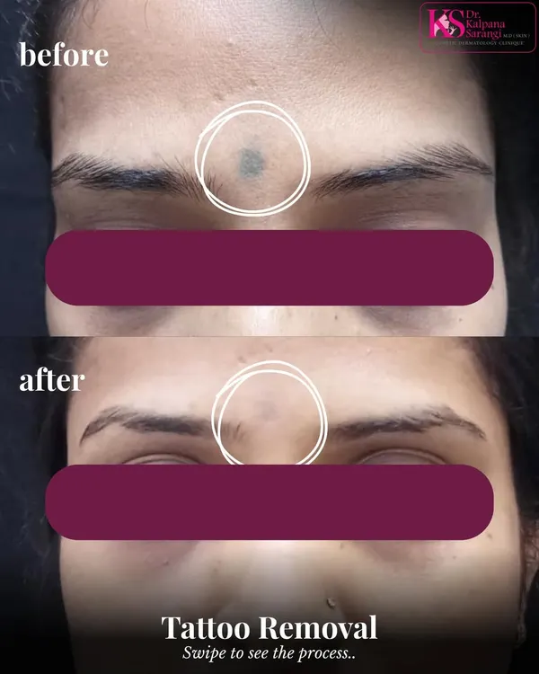 Here you can see the significant fading of a facial tattoo after a course of laser tattoo removal sessions. My approach focuses on gradually breaking down the ink pigment with each treatment, allowing the body to clear it naturally. This ensures the skin's integrity is protected while achieving clear, impressive results.
