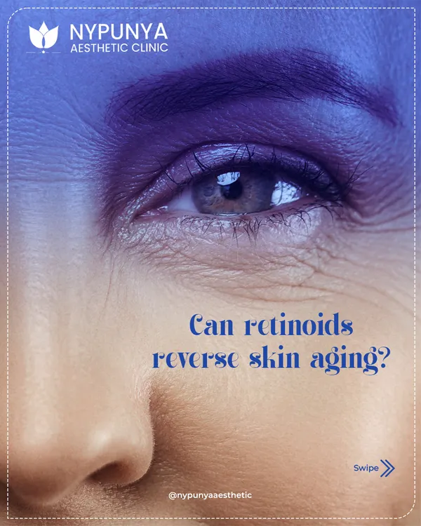Can retinoids truly reverse skin aging? While they are excellent for smoothing fine lines and preventing premature aging, they cannot fully reverse deep-set signs of aging on their own.