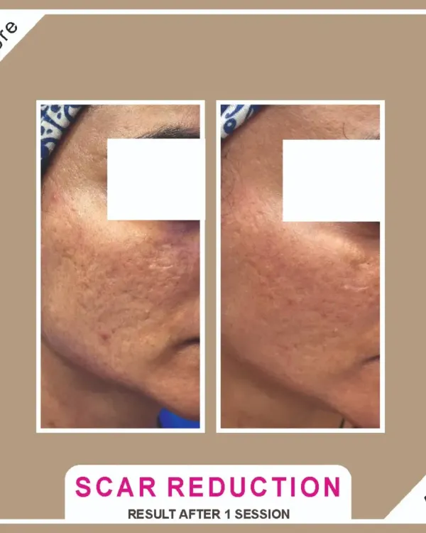 This before and after shows a significant reduction in acne scarring after just one session of a combination treatment. CO2 laser and MNRF are my gold-standard technologies for remodeling the skin and delivering fantastic results.