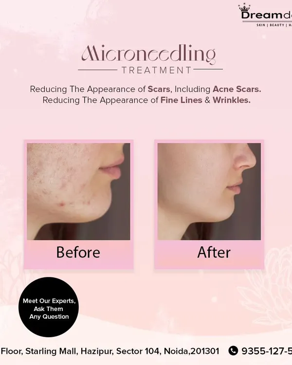 A powerful before-and-after image showcasing the effectiveness of Microneedling for reducing the appearance of acne scars and improving skin texture.