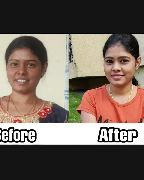 This before and after photo shows how I removed a stubborn tan using a simple, homemade mask. You can see how my skin tone became much brighter and more even, all with natural ingredients you can find at home. This is one of my most effective tan removal remedies.