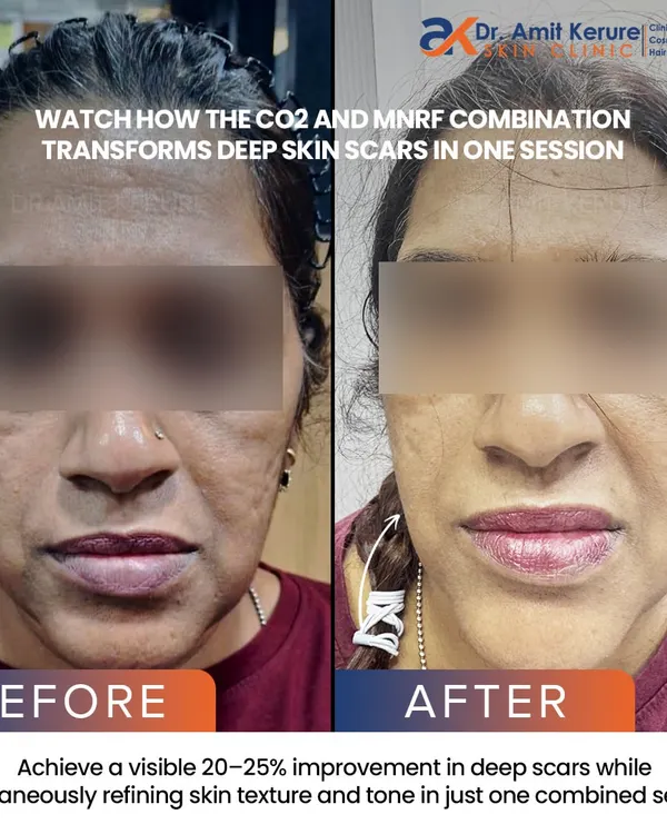 This before and after shows the visible reduction of deep facial scars after just one combination session of CO2 Fractional Laser and MNRF, resulting in a 20-25% improvement and smoother skin texture.