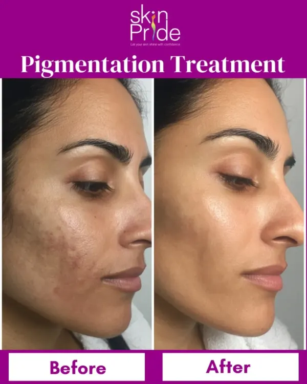 This before-and-after shot shows the real, visible change we can achieve for pigmentation issues. We create a personalized treatment plan to help you get clear, even-toned skin you can feel confident in.