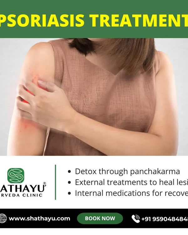 Our Ayurvedic Psoriasis treatment goes beyond surface-level care. We use a three-pronged approach: detoxification through Panchakarma, external treatments to heal lesions, and internal medications for a complete recovery.