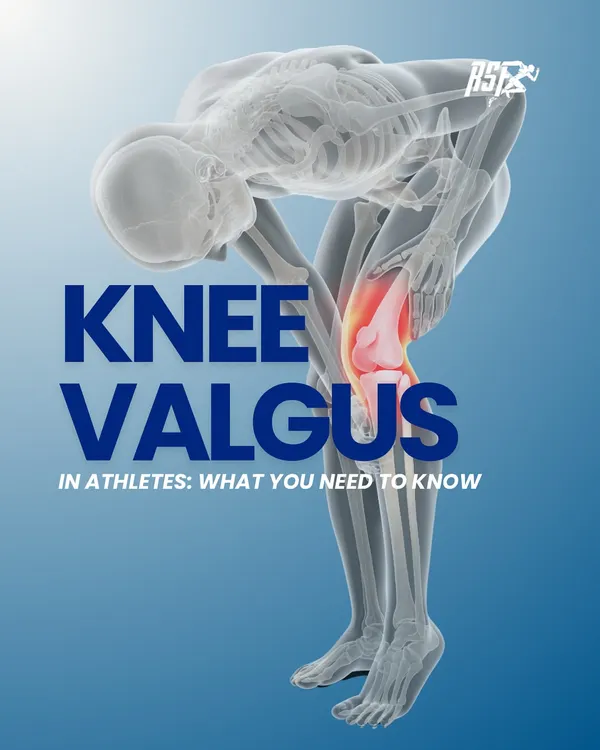 An introduction to Knee Valgus, a common movement dysfunction in athletes that can lead to significant injury if not addressed.