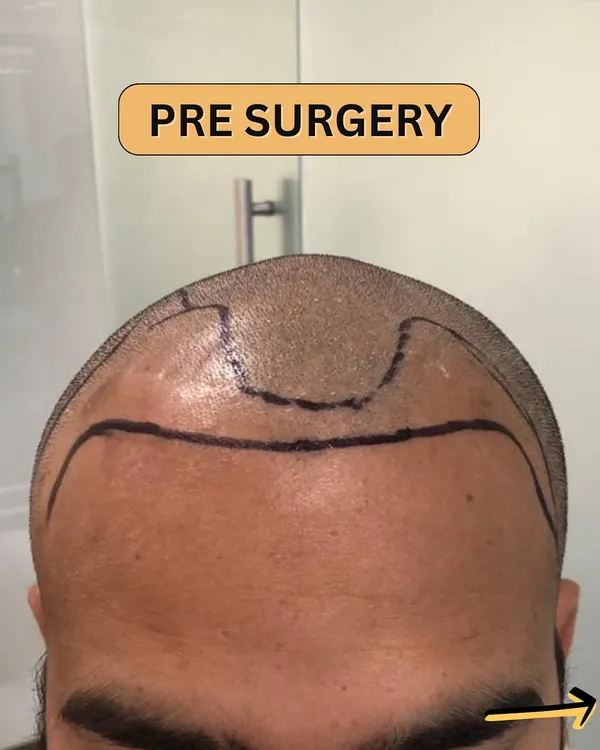 The journey begins with precise planning. Here, we've marked the new hairline pre-surgery, designing a natural frame for the face.