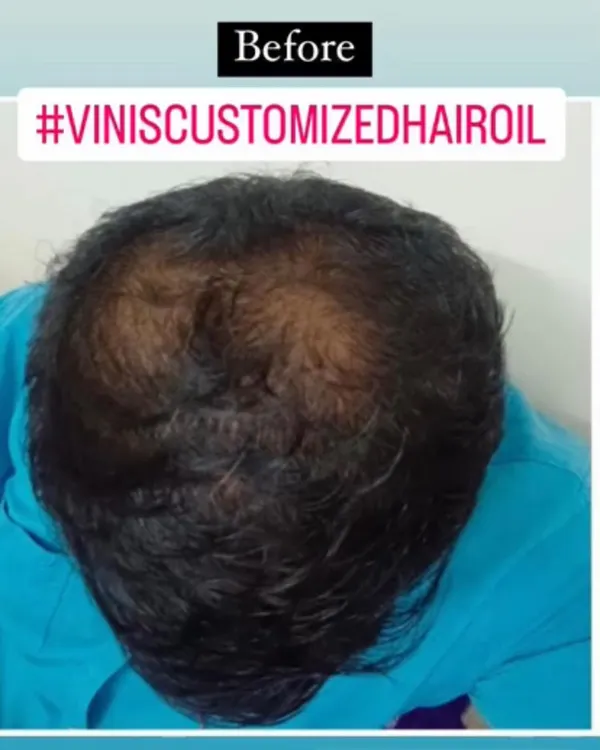 This is a 'before' photo from a client who was experiencing significant hair thinning on the crown area. He was looking for a natural way to address it.