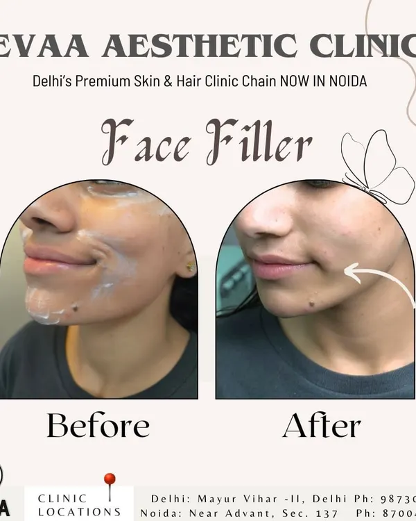 A clear before-and-after result of a face filler treatment. Notice the enhanced definition in the lower face and chin area, creating a more sculpted and balanced profile.