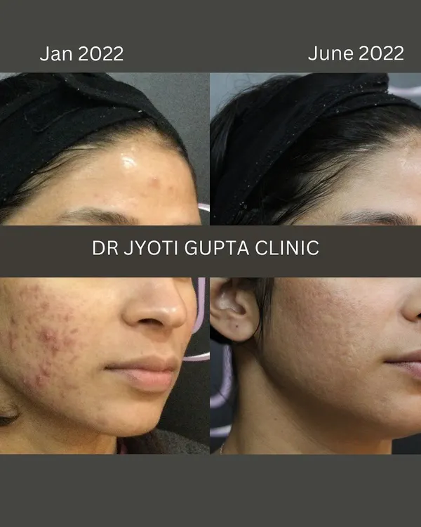 This is a six-month journey of one of my patients. We addressed active acne and began revising the resulting scars using a personalized combination of medical treatments and in-clinic procedures. Clear skin is a process that requires patience, and the results are worth it.