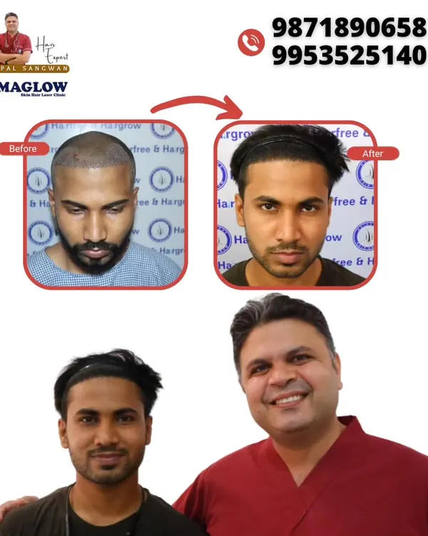 This client received 2262 grafts via the FUE technique, and this photo shows his results just 8 months post-procedure. Notice the restored hairline and the significant increase in density on the frontal and mid-scalp areas.