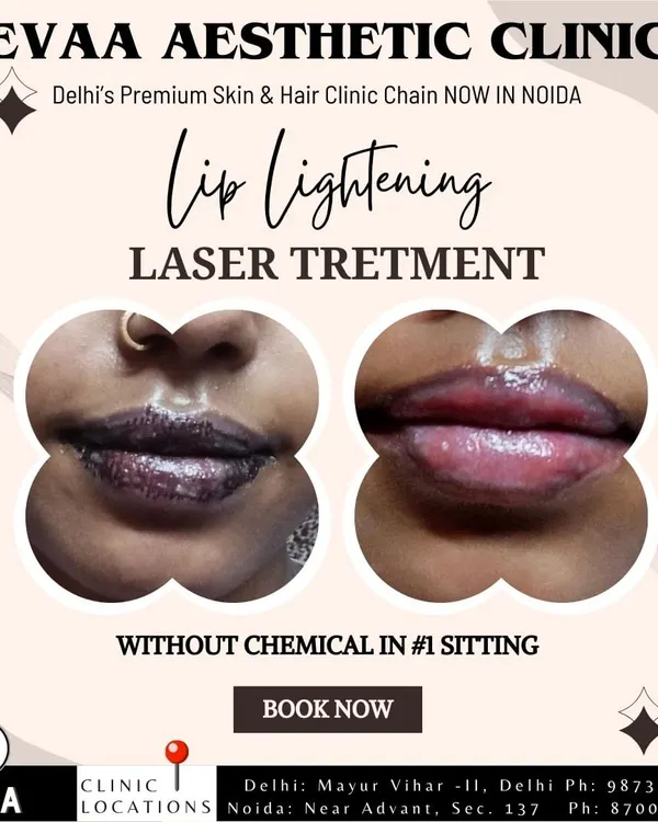 A dramatic before and after of our laser lip lightening treatment, showing significant improvement in pigmentation in just one sitting without the use of chemicals.