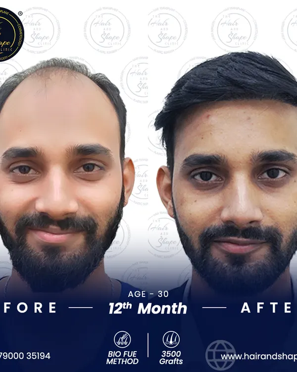 This is the power of a well-planned hair transplant. After 12 months, this patient not only regained his hair but also a renewed sense of confidence. We used the BIO FUE method with 3500 grafts to achieve this dense, natural-looking result.